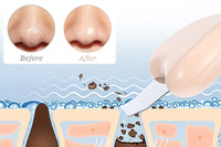 2Pcs Blackhead Remover Skin Scrubber Face Scraper Tools