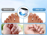 Effective Nail Fungus Laser Treatment